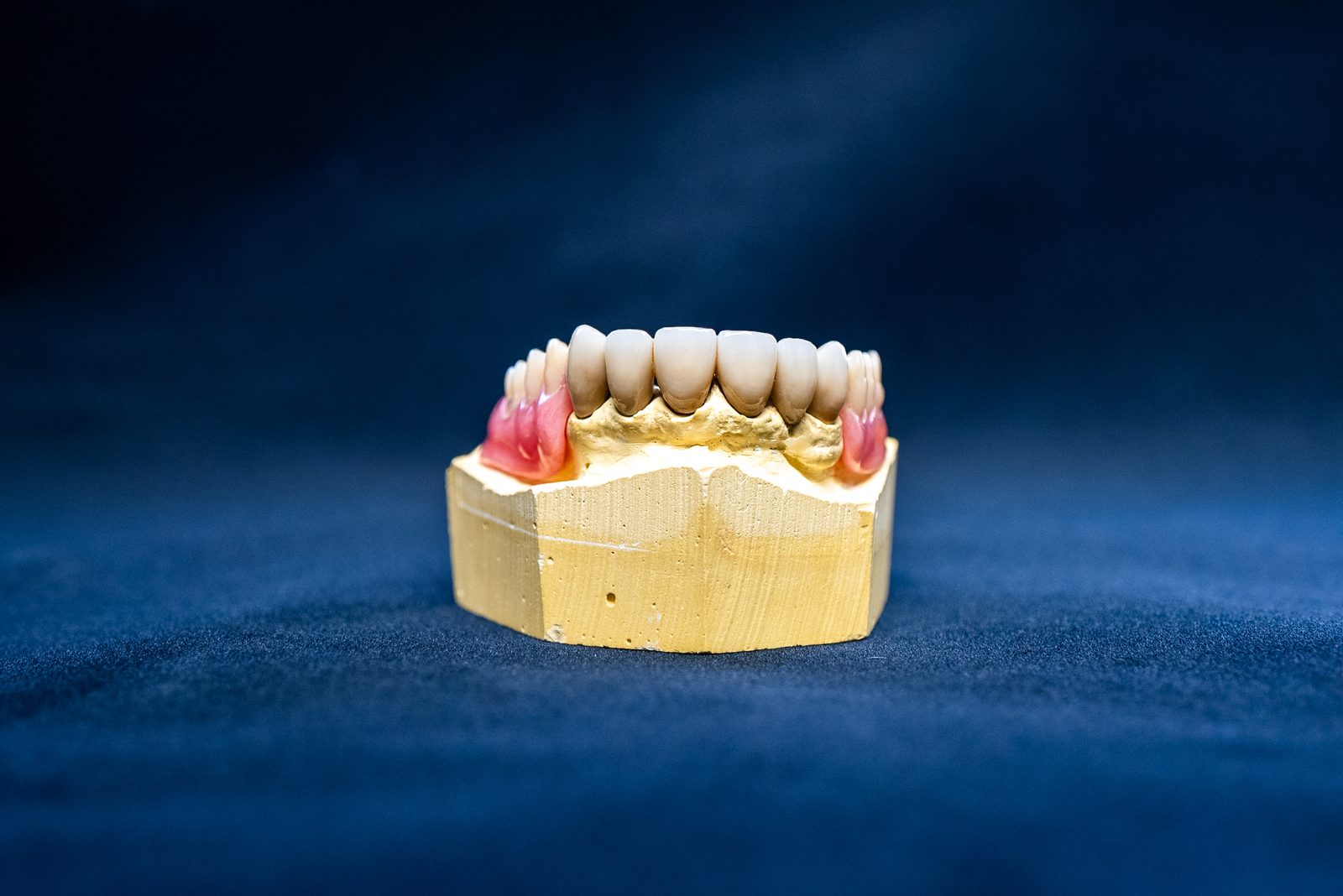 All-on-4 dental implant model showing four strategically placed implants supporting a full arch of teeth at Elite Prosthetic Dentistry in Bethesda