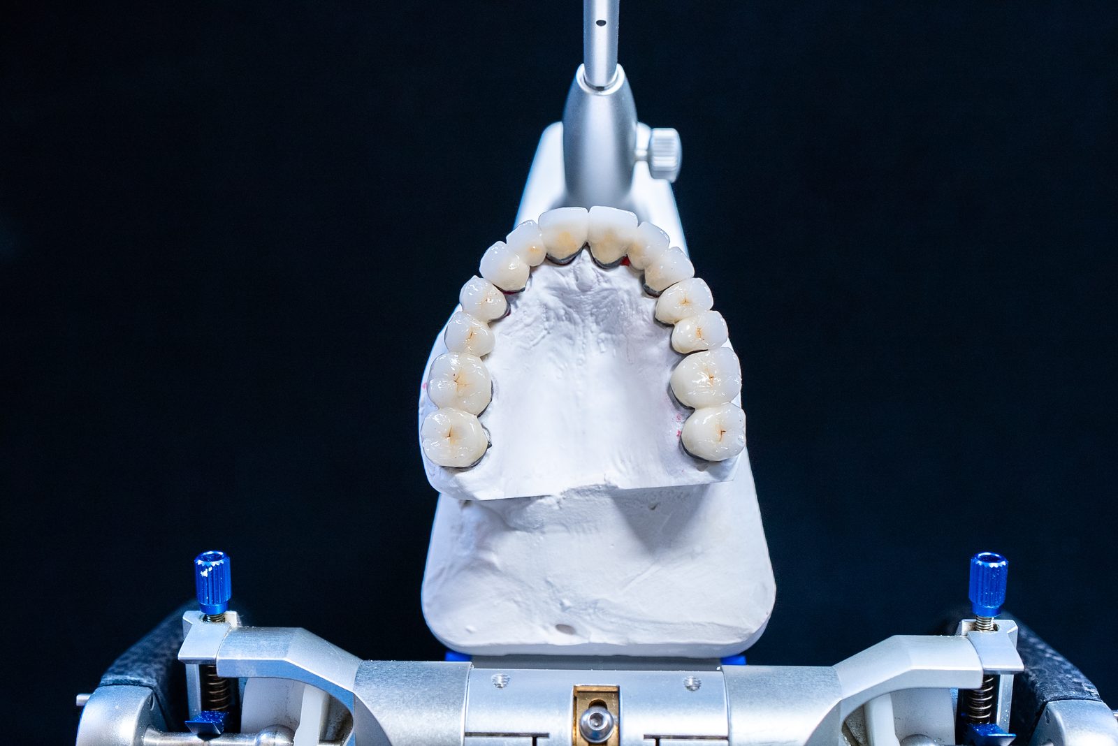 Dental implant arch restoration model showing multiple teeth replaced with implant-supported prosthetics