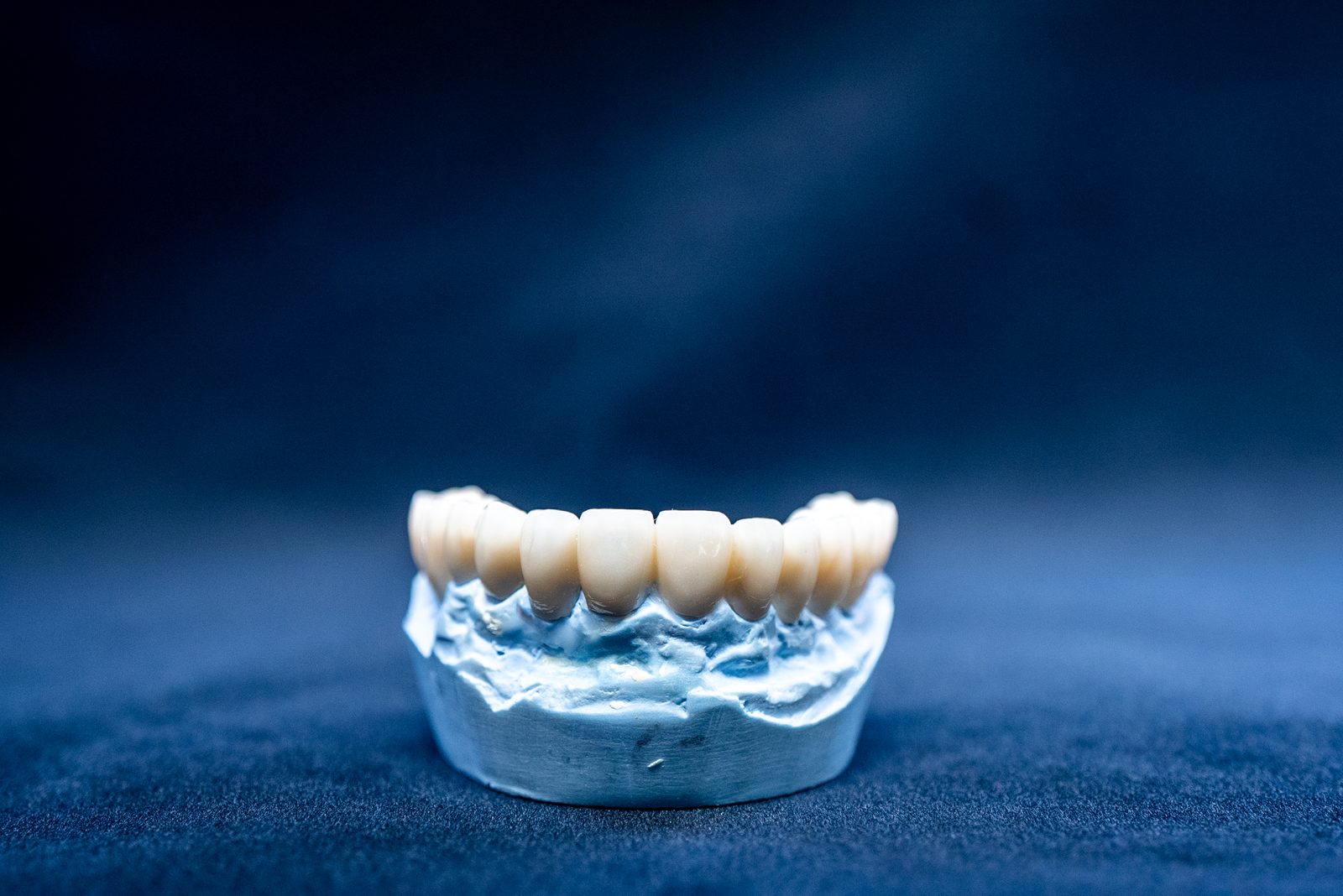 Side-by-side dental implant and bridge prosthetic models showing the structural differences between these tooth replacement options