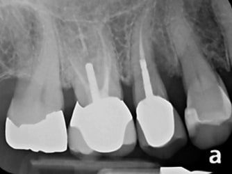 X-ray showing a failed dental implant that requires diagnosis and intervention by a specialist prosthodontist