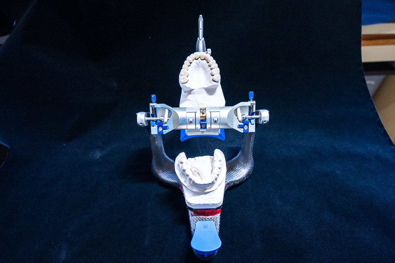 Full arch dental implant prosthetic model showing angled posterior implants for maximum bone engagement