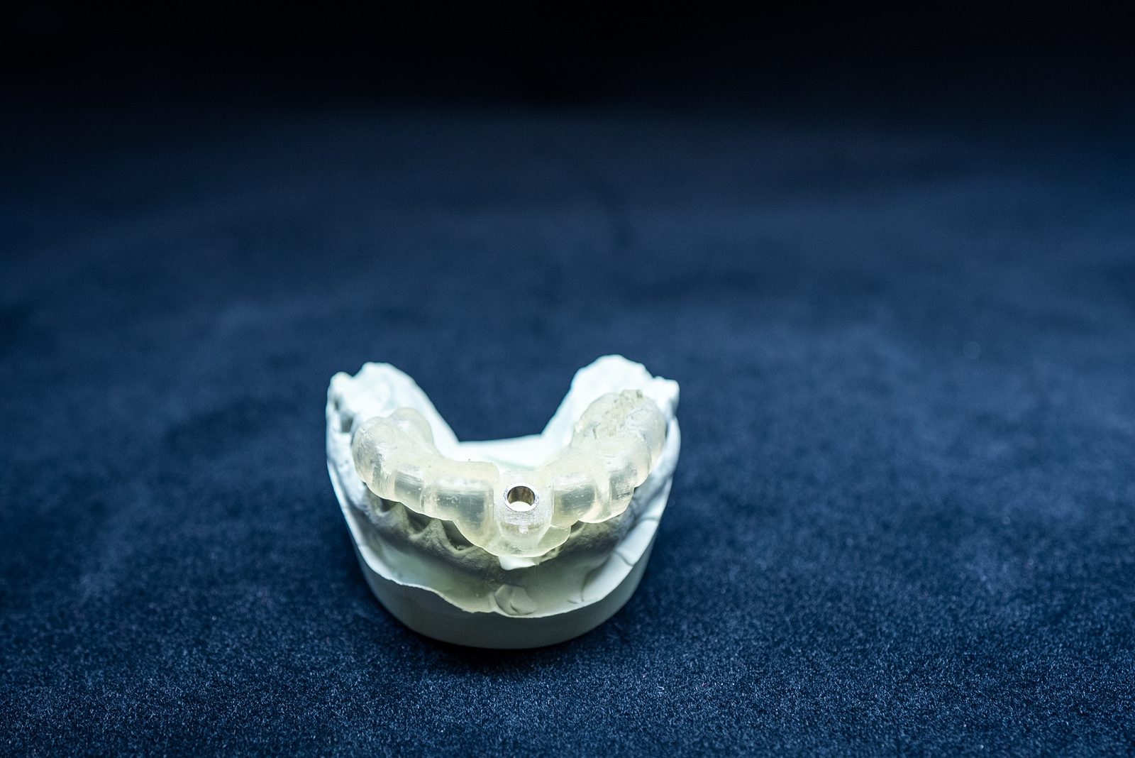Dental implant crown restoration model showing independent support without affecting adjacent teeth