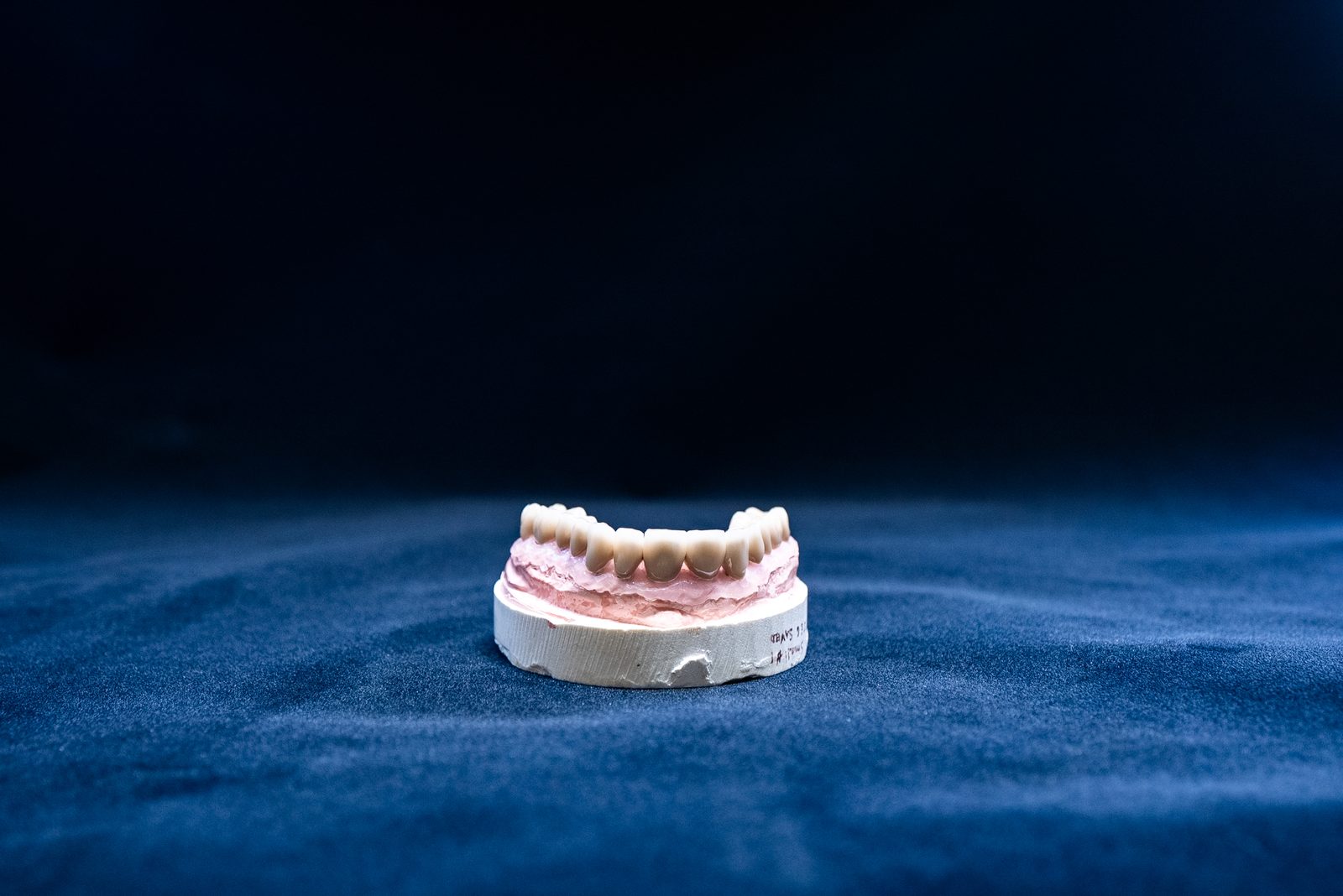 Implant-supported denture model showing how implants secure a full denture in place for Bethesda patients