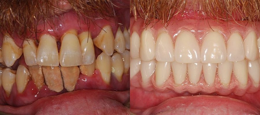 Same-day immediate dental implant placement allowing patients to leave with teeth in one appointment